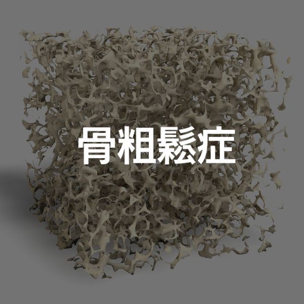 大阪 骨粗鬆症治療